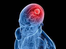 Glioblastoma Astrocytoma Meningioma Schwannoma