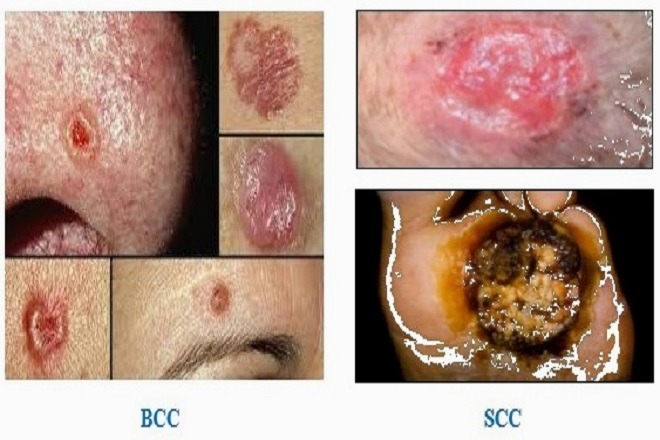 درمان سرطان های پوستی (BCC-SCC)