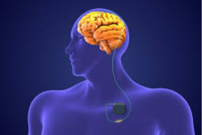 جراحی پارکینسون به روش DBS